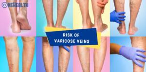 The Dangers of Varicose Veins