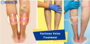 Veins Treatment Options in Singapore, What you need to know