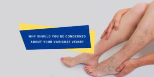 Should You Be Worried About Varicose Veins
