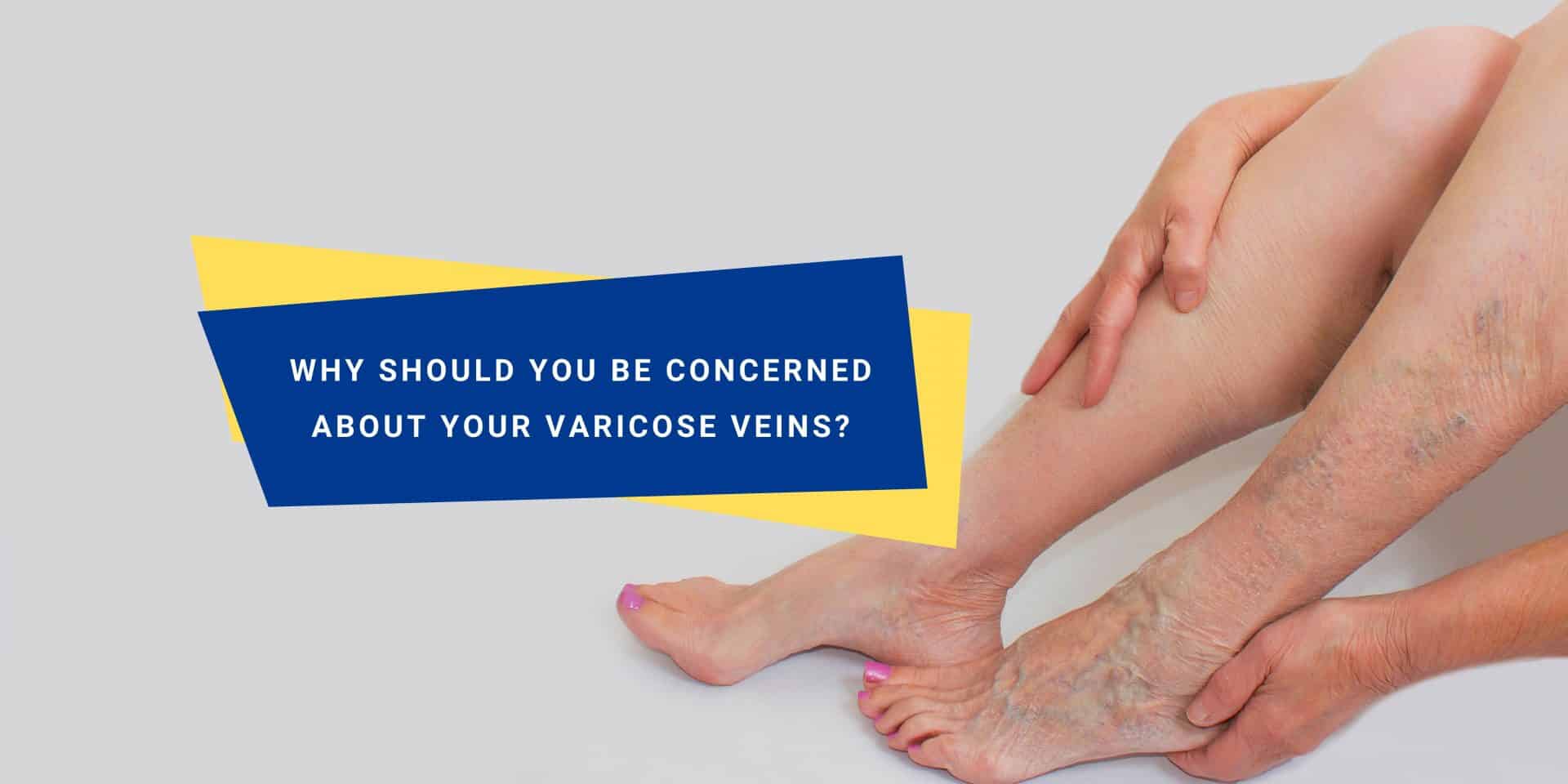 Should You Be Worried About Varicose Veins? OneHealth.sg Singapore