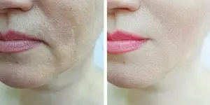 fillers