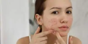 purging acne